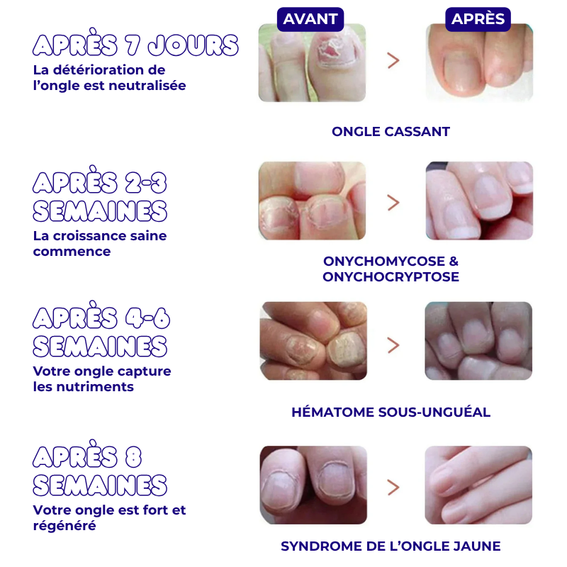32x Patchs de Traitement Anti-Mycose pour Pieds