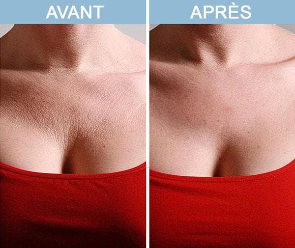 Lot de 2 Patchs anti-rides pour la poitrine